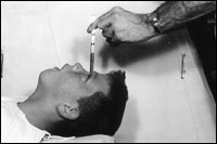 Picture of Howard Dully, age 12, during lobotomy procedure, with leucotome inserted in eye socket. Picture of Howard Dully, age 12, during lobotomy procedure, with leucotome inserted in eye socket.